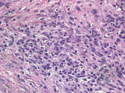 Langerhans Cells in Bone marrow biopsy 2