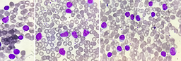 CLL-1