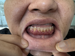 Gingival infiltration by acute myeloid leukemia, in a patient with a monocytic subtype