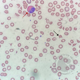 Shiga toxin 2-induced hemolytic uremic syndrome in an adult #1