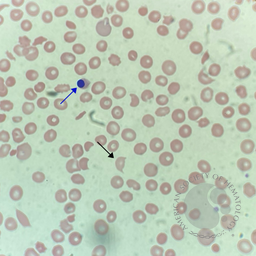 Shiga toxin 2-induced hemolytic uremic syndrome in an adult #2