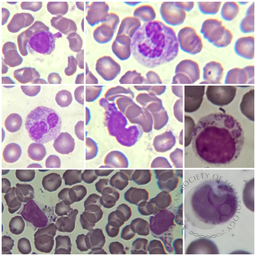 Image 1: Chediak-Higashi peripheral blood leukocytes.