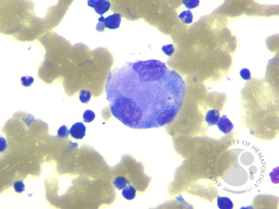 Secondary Hemophagocytic Lymphohistiocytosis in a Case of Pulmonary Adenocarcinoma with Multiple Metastases and Concurrent Infection 1