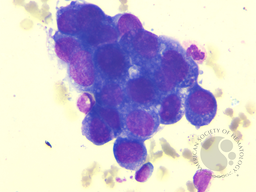 Secondary Hemophagocytic Lymphohistiocytosis in a Case of Pulmonary Adenocarcinoma with Multiple Metastases and Concurrent Infection 2