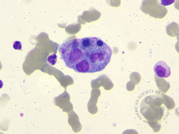 Secondary Hemophagocytic Lymphohistiocytosis in a Case of Pulmonary Adenocarcinoma with Multiple Metastases and Concurrent Infection 3