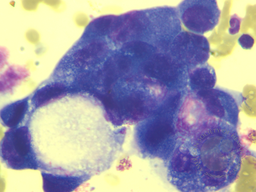 Secondary Hemophagocytic Lymphohistiocytosis in a Case of Pulmonary Adenocarcinoma with Multiple Metastases and Concurrent Infection 4