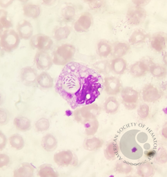 DETECTION OF BACTEREMIA ON PERIPHERAL BLOOD SMEAR.