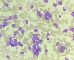 Acute Basophilic Leukaemia