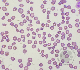 Thrombotic Thrombocytopenic Purpura