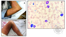 An Anticonvulsant (Levipil) induced Drug Reaction with Eosinophilia and Systemic Symptoms (DRESS)