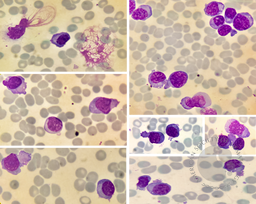 Plasma cell dyscrasia