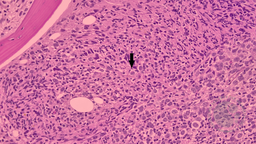 Richter transformation, DLBCL cells with erythrophagocytosis 2