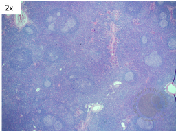 Idiopathic Multicentric Castleman Disease