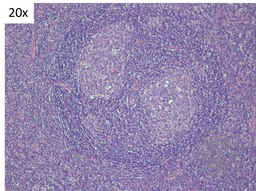 Idiopathic Multicentric Castleman Disease- Twinning