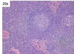 Idiopathic Multicentric Castleman Disease- Onion skinning