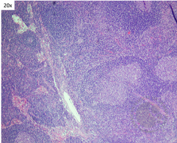 Idiopathic Multicentric Castleman Disease- Lollipop