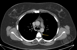 Idiopathic Multicentric Castleman Disease CT Image