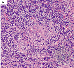 Unicentric Castleman Disease- Twinning