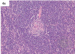 Unicentric Castleman Disease- Lollipop