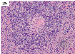 Unicentric Castleman Disease- FDC 1