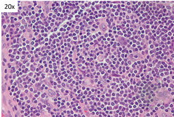 Unicentric Castleman Disease- FDC 3