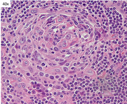 Unicentric Castleman Disease- FDC 4