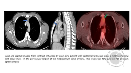 Unicentric Castleman Disease- CT Images