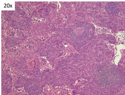 TAFRO- Vascular proliferation