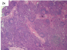 TAFRO- regressed germinal centers