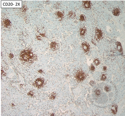 TAFRO- CD20