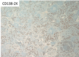 TAFRO- CD138