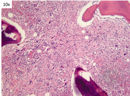 TAFRO- Bone marrow fibrosis 1