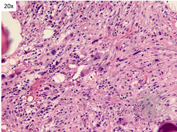 TAFRO- Bone marrow fibrosis 2