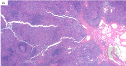 HHV8 Positive MCD- Regressed Germinal centers