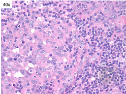 HHV8 Positive MCD- Plasmablasts 1