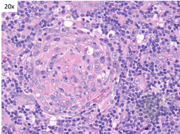 HHV8 Positive MCD- Plasmablasts 2