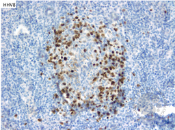 HHV8 Positive MCD- HHV8