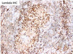 HHV8 Positive MCD- Lambda IHC