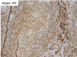 HHV8 Positive MCD- Kappa IHC