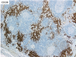 HHV8 Positive MCD- CD138