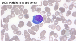 HHV8 Positive MCD- Plasmablasts on peripheral smear