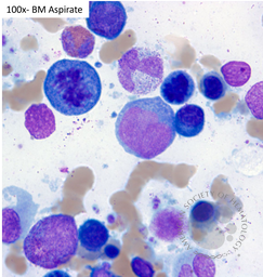 HHV8 Positive MCD- Plasmablasts on Bone Marrow Aspirate