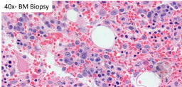 HHV8 Positive MCD- Plasmablast on Bone Marrow biopsy
