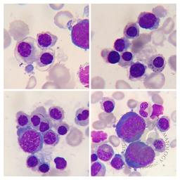 Refractory Anemia with Ring Sideroblasts