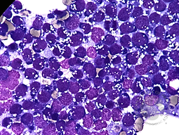 Burkitt's Lymphoma