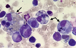Hemophagocytic Lymphohistiocytosis