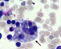 Macrophage with phagocytosed red blood cells