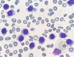 Macrophage with phagocytosed red blood cells