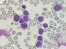 Mantle Cell Lymphoma