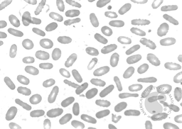 Hereditary Elliptocytosis